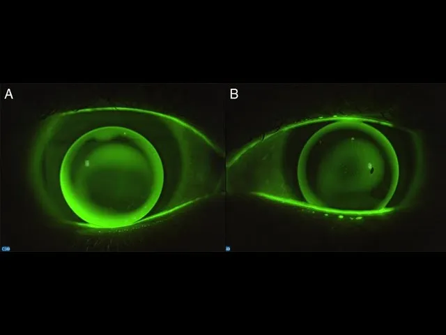 RGP lens fluorescein: ideal vs steep fit