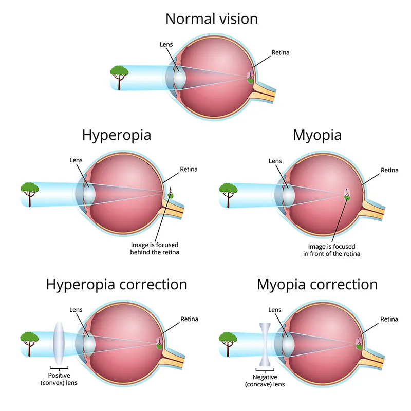 Myopia and hyperopia light focusing and correction