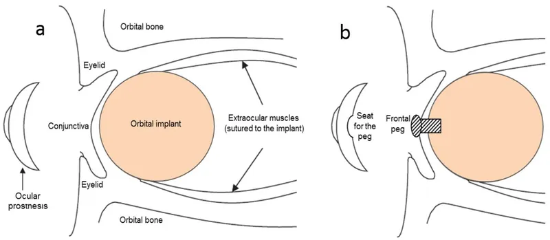 Integrated vs non-integrated orbital implants diagram