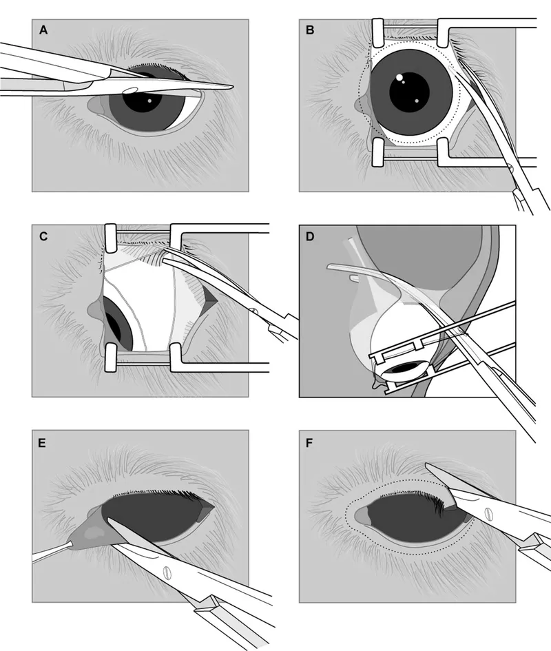 Enucleation surgical steps