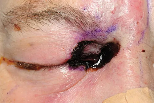 Mucormycosis with black eschar on eyelid