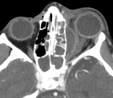 CT: Orbital cellulitis with proptosis and ethmoid sinusitis
