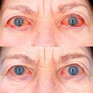 Thyroid Eye Disease: Before and After Treatment