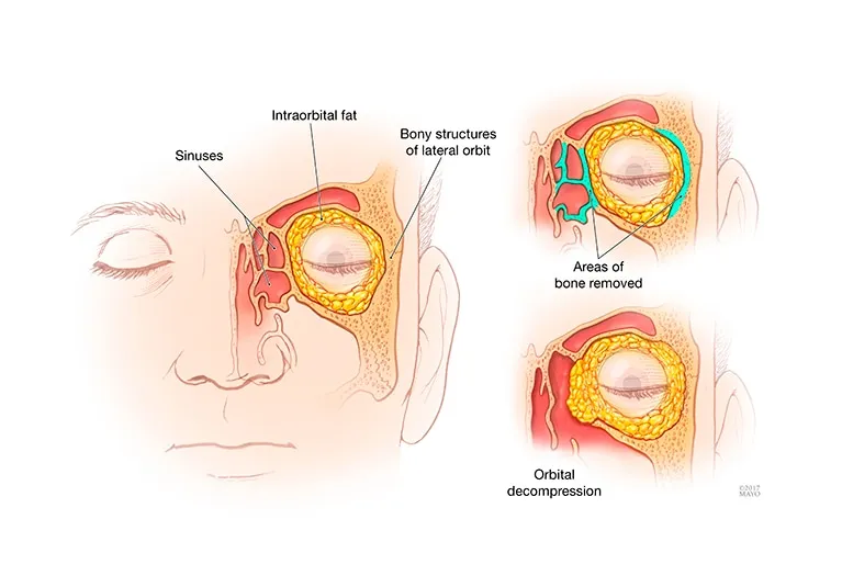 Orbital decompression bone removal areas