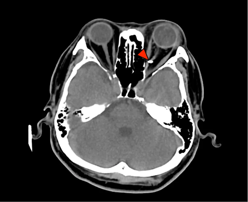 CT scan showing intraorbital foreign body