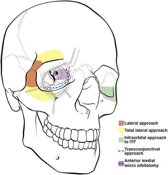 Orbital tumor surgical approaches