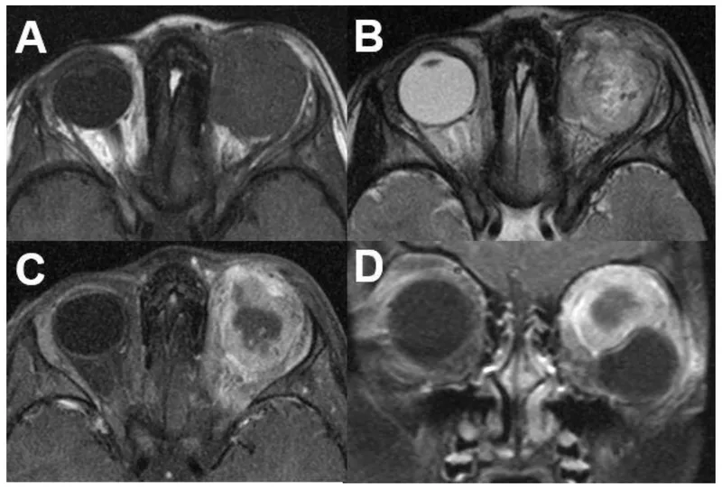 MRI showing metastatic tumor in orbit