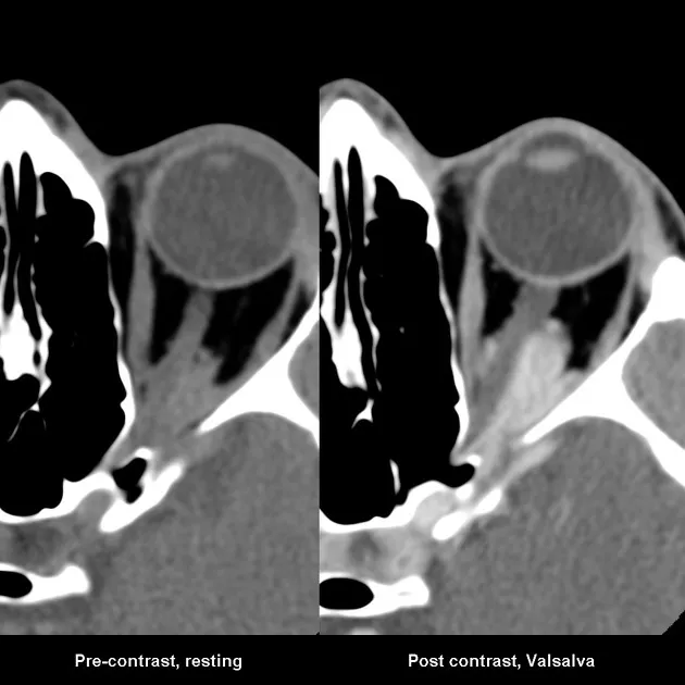 Orbital varix CT pre- and post-Valsalva