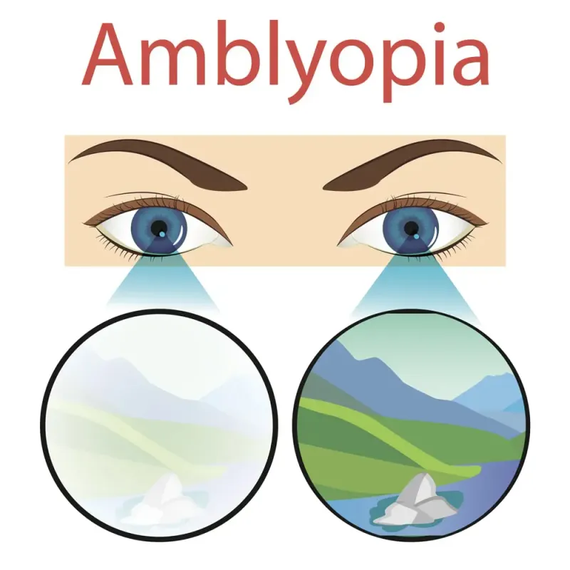 Amblyopia: Blurred vs. Clear Vision