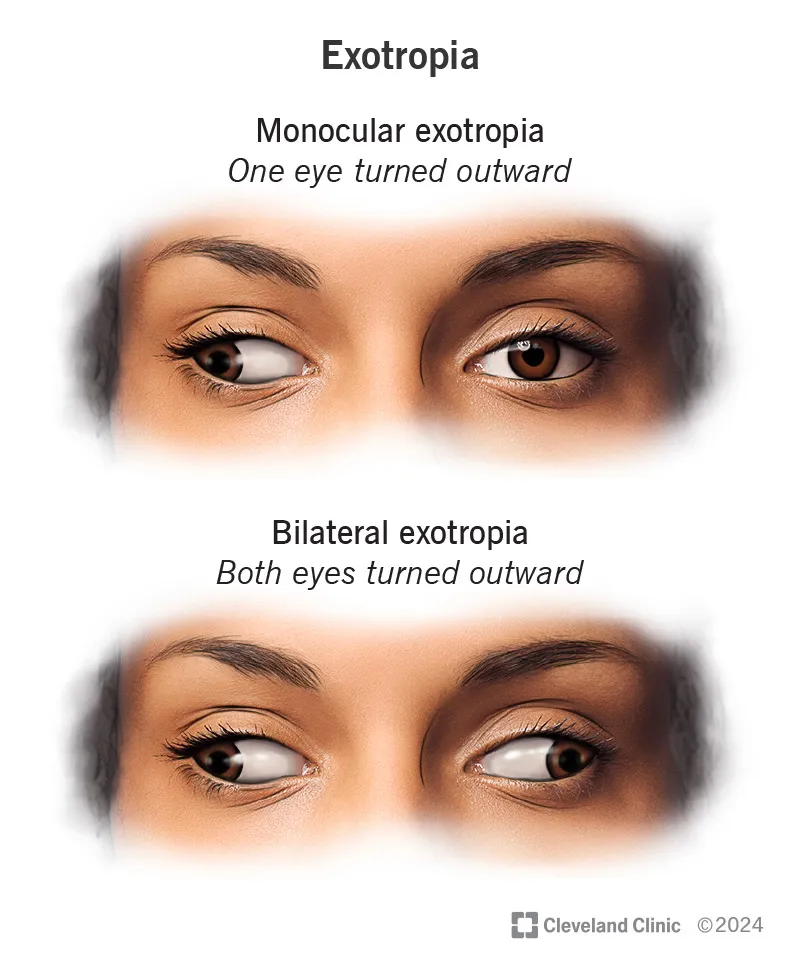 Monocular vs. Bilateral Exotropia
