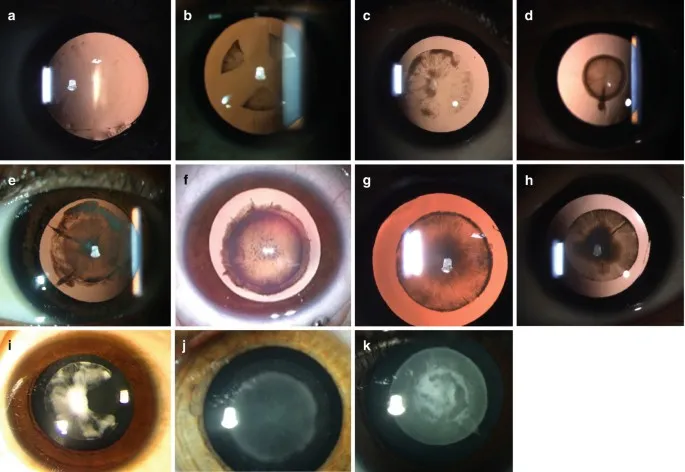 Pediatric Cataract Morphologies