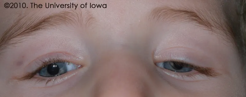 CFEOM with bilateral ptosis and downgaze fixation