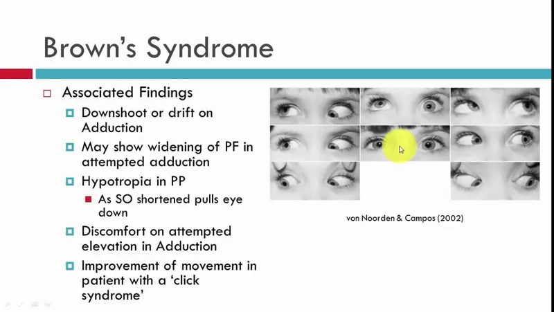 Brown's Syndrome Findings and Eye Movements