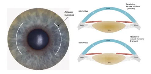 Arcuate incisions for astigmatic keratotomy