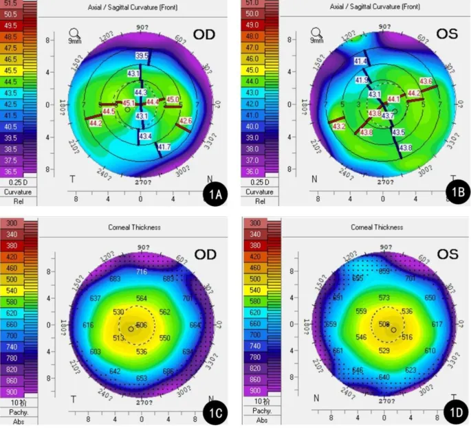 Post-LASIK Ectasia Topography and Pachymetry
