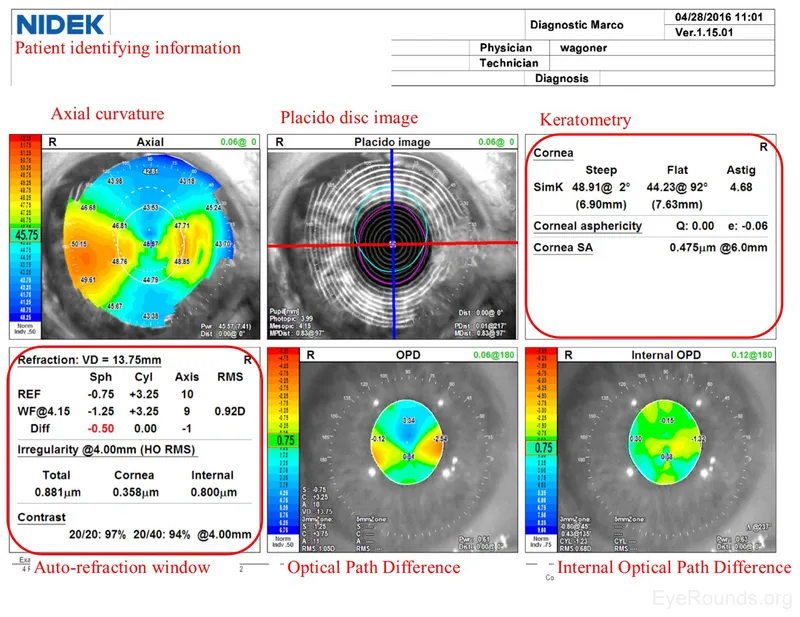 Corneal Topography and Tomography Report