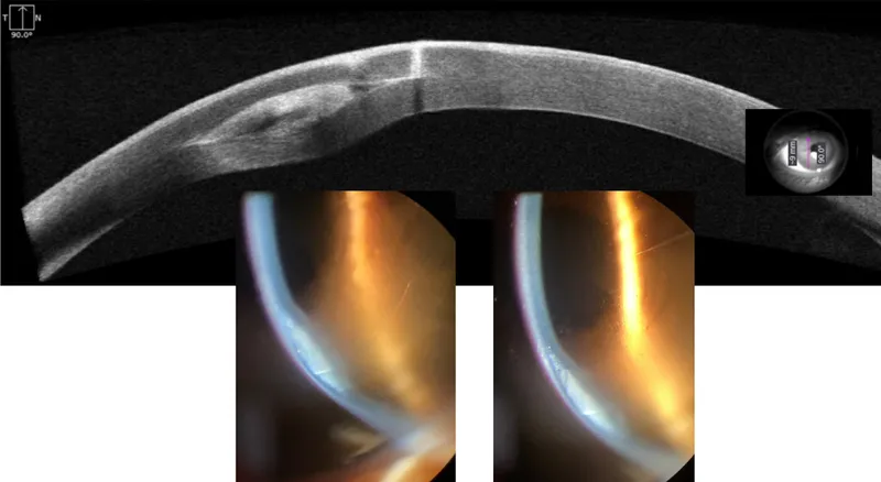 ICRS segment extrusion with OCT and slit lamp views