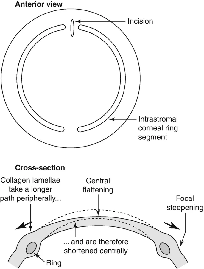 Intrastromal Corneal Ring Segments: Anterior & Cross-section
