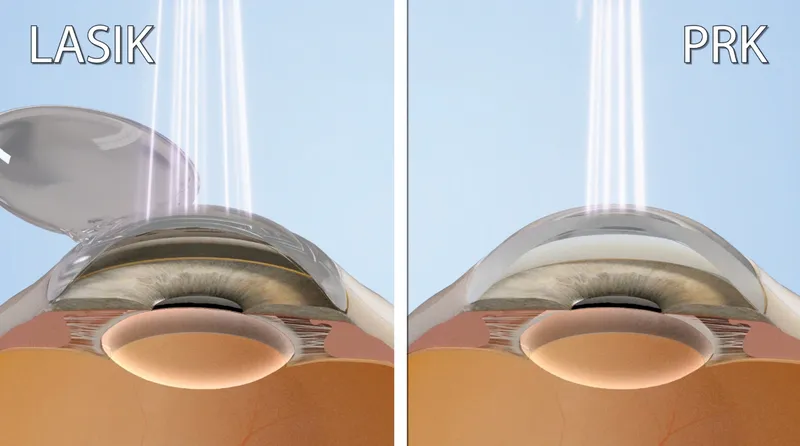 LASIK vs PRK corneal flap comparison