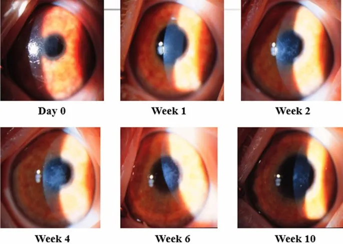 Corneal haze progression after PRK