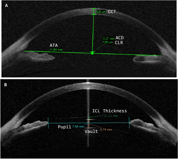 OCT showing ACD, ATA, and ICL measurements