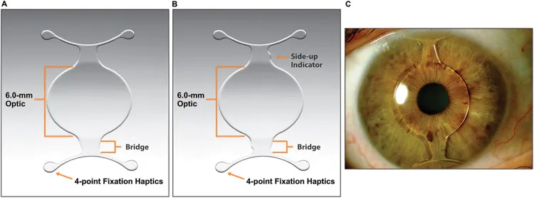 Iris-claw Phakic IOL Diagram and In-situ Image