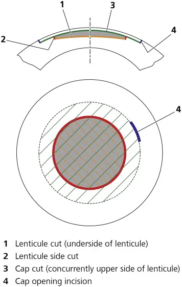 SMILE Lenticule and Cap Cuts Diagram
