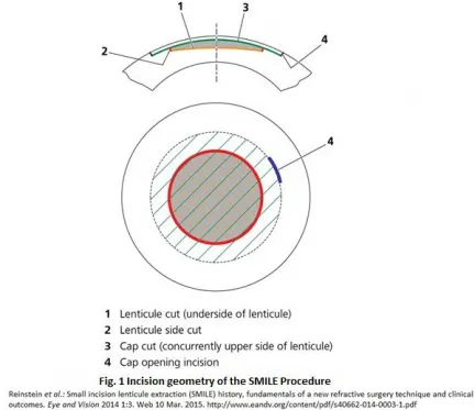 SMILE Procedure Incision Geometry Diagram