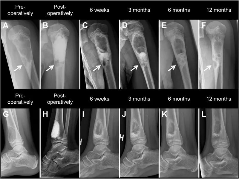 X-ray progression of osteomyelitis treatment