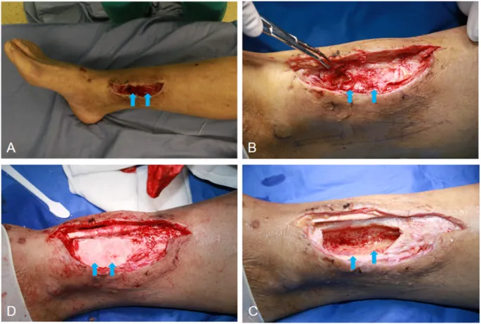 Surgical debridement of osteomyelitis