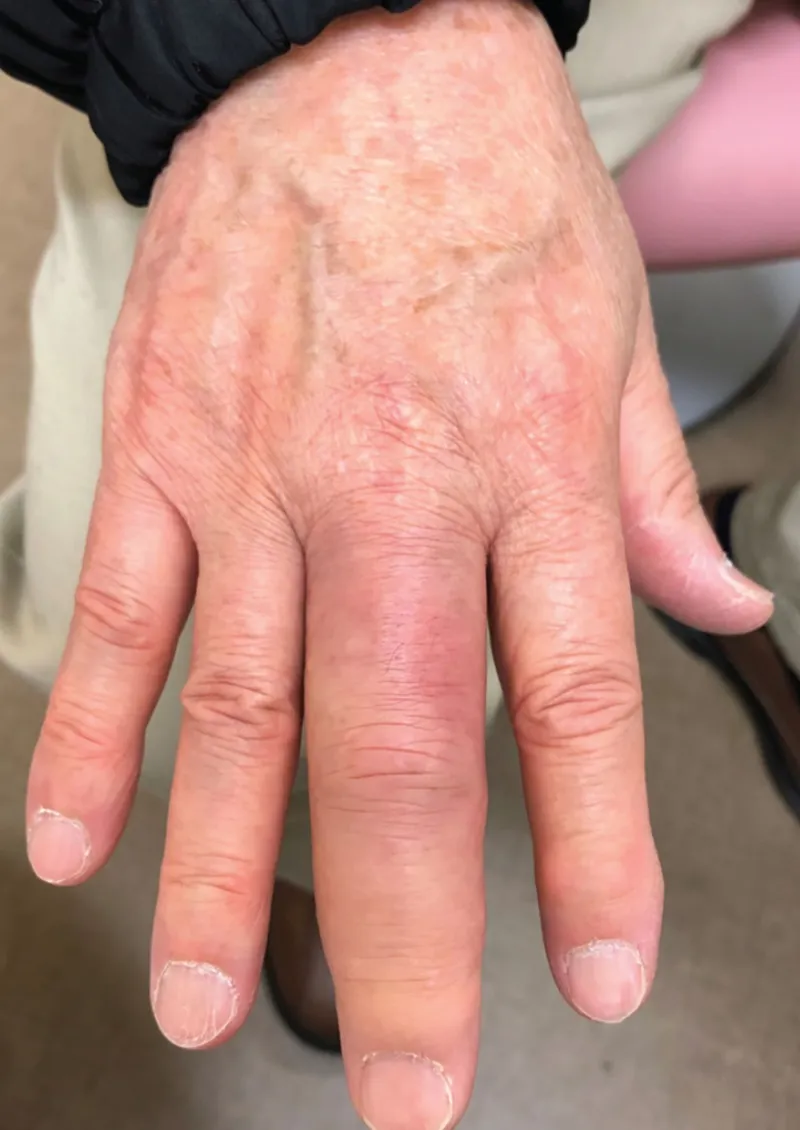 Dactylitis (sausage digit) in reactive arthritis