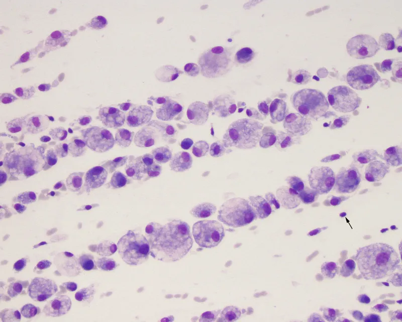 Synovial fluid microscopy: neutrophils & bacteria