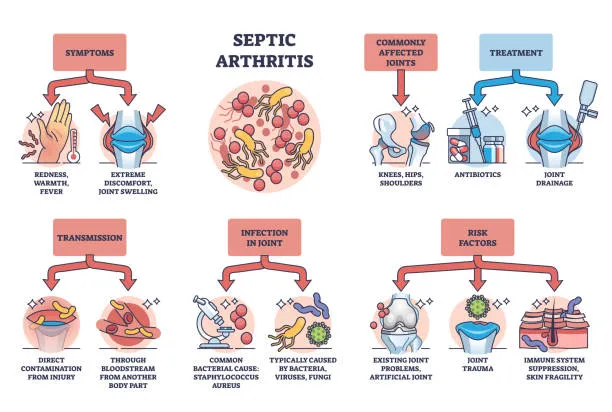 Septic Arthritis Infographic