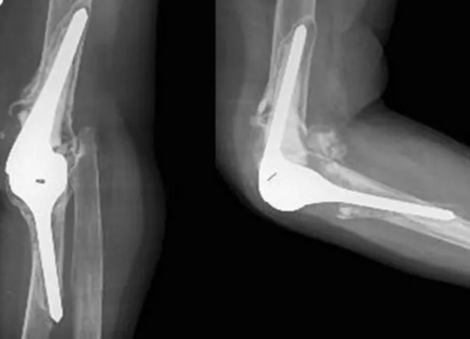 Radiograph showing ulnar component loosening