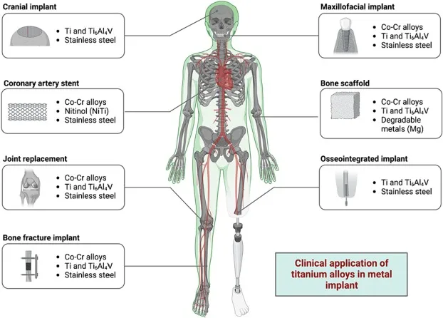 Implant materials by location: Ti, Co-Cr, SS, Nitinol, Mg