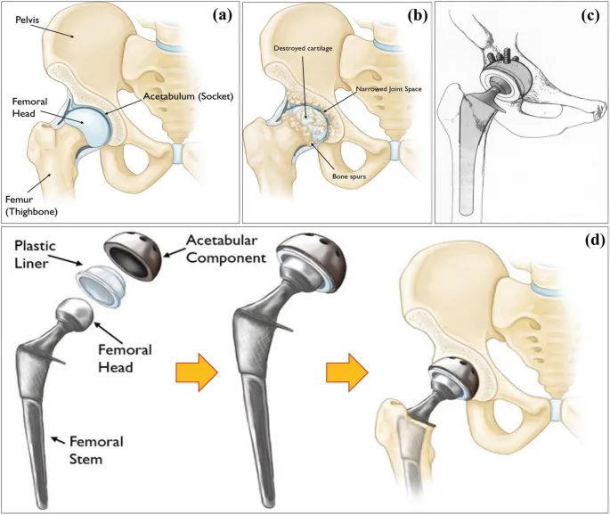 Hip Arthroplasty Implant Components