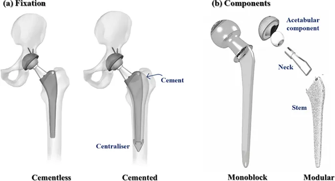 Cemented vs Cementless Hip Stem Fixation and Components