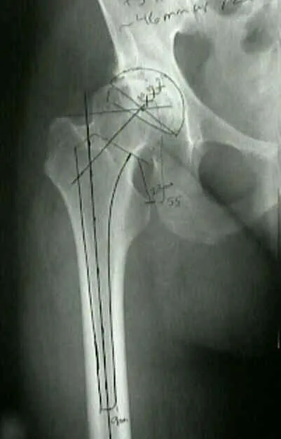 Hip Arthroplasty Planning X-ray with Template