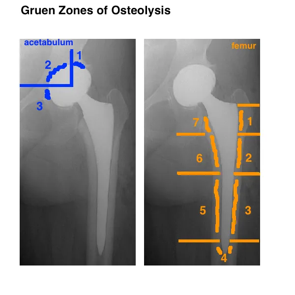 Gruen Zones of Osteolysis in Hip Arthroplasty