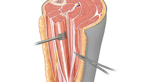 Sciatic nerve during posterior approach to hip