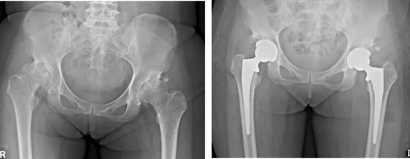 Pre- and post-op X-rays of bilateral total hip arthroplasty