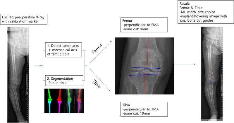 Preoperative templating for TKA