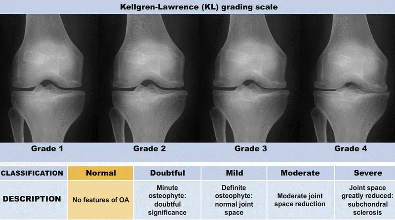 Kellgren-Lawrence (KL) grading scale for knee OA