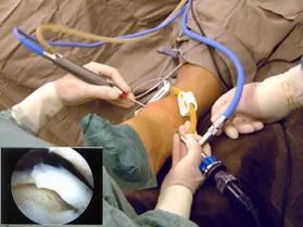 Ankle arthroscopy with arthroscopic view inset