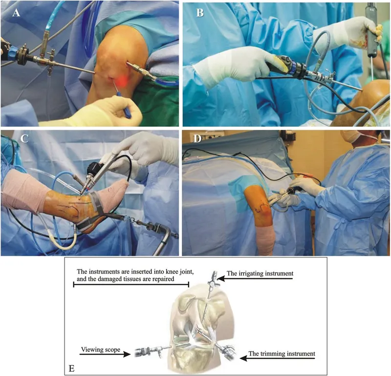 Knee Arthroscopy Procedure and Instruments
