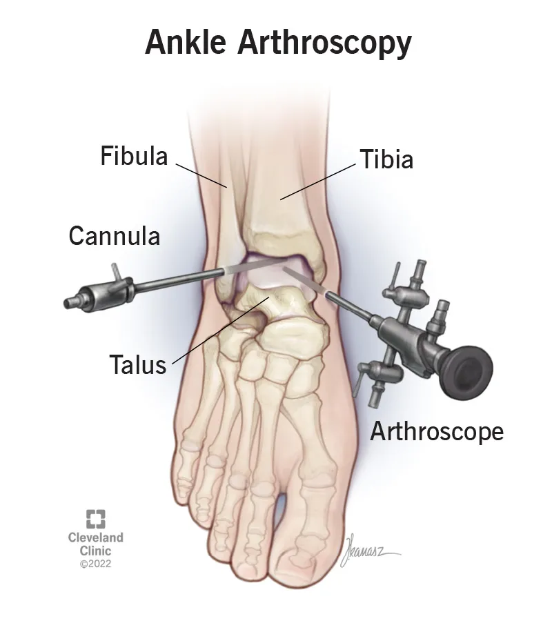 Ankle Arthroscopy Procedure