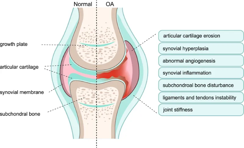 Normal vs. Osteoarthritic Joint