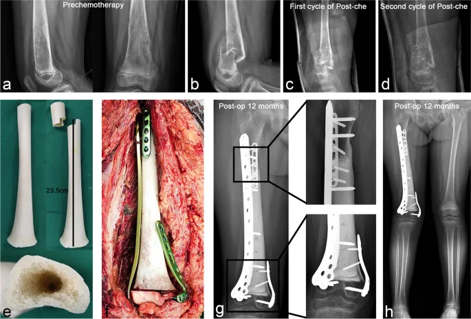 Composite graft reconstruction of distal femur