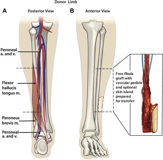 Free fibula graft with vascular pedicle