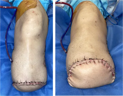 Post-amputation stump with sutures and drainage tube